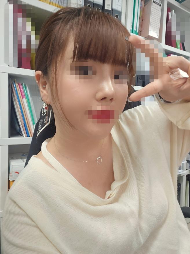 ศัลยกรรมจมูกครั้งแรก