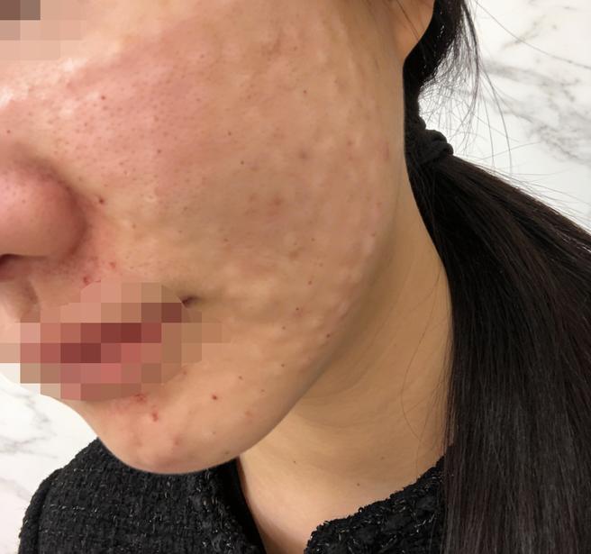 트러블 반복돼서 쥬베룩 받았는데 피부 진정되는 느낌이에요 ㅎㅎ