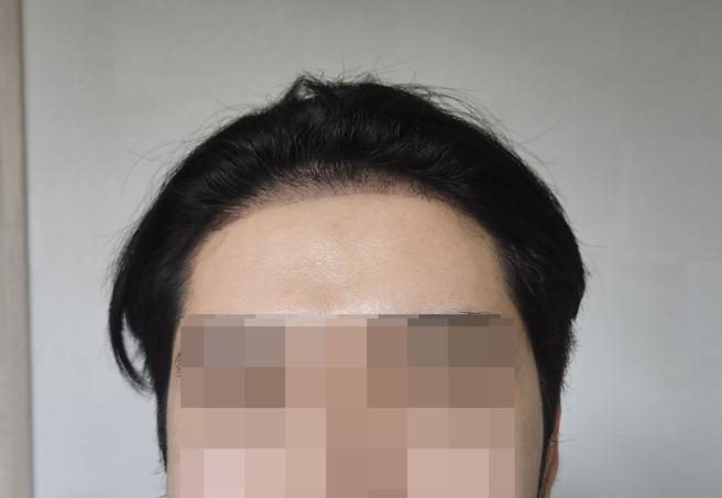 Non-incisional hair transplantation