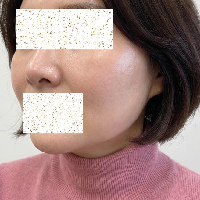 스컬트라 3일차, 아직 좀 부어있어요~ 붓기 빠지면 어떻게 될지 기대 중