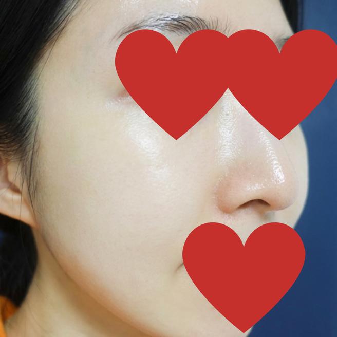 스컬트라+리쥬란 4주차, 피부에 윤기가 돌기 시작했어요