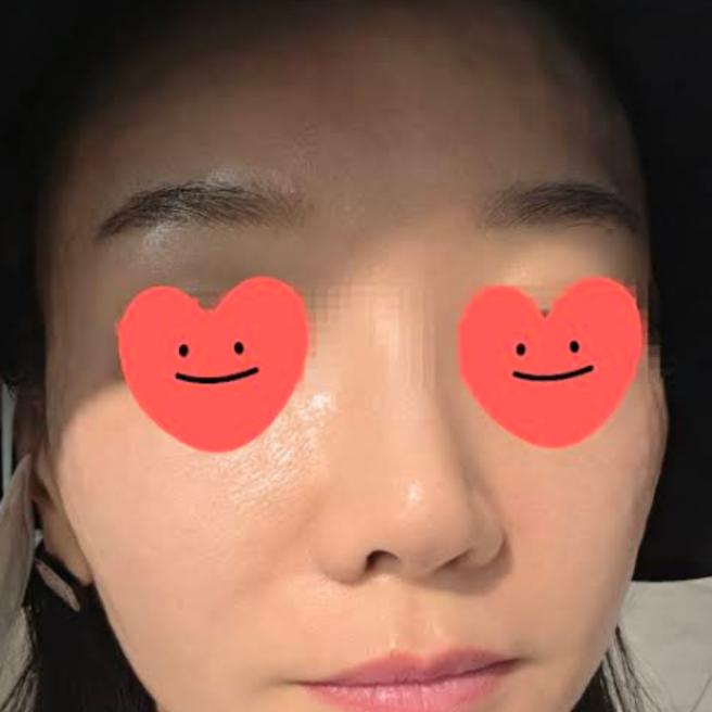 리쥬란 6일차, 피부결이 눈에 띄게 매끈해졌어요
