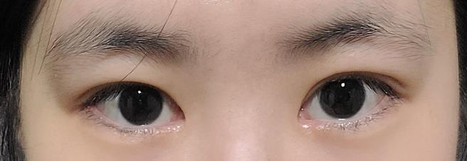 แก้ไขรูปตาและกล้ามเนื้อตาอ่อนแรง