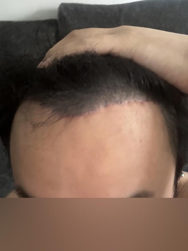額頭縮小