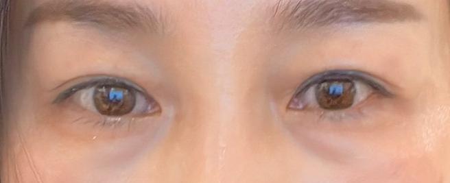 แก้ไขรูปตาและกล้ามเนื้อตาอ่อนแรง