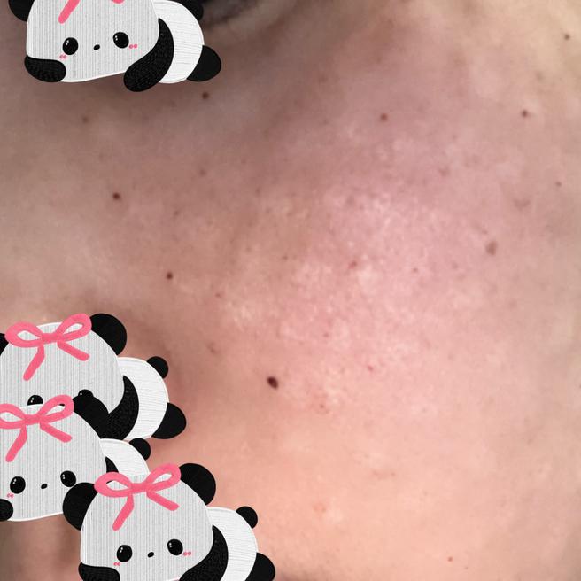 서울아이 리쥬란 1일차, 수면으로 편안하게 받은 후기
