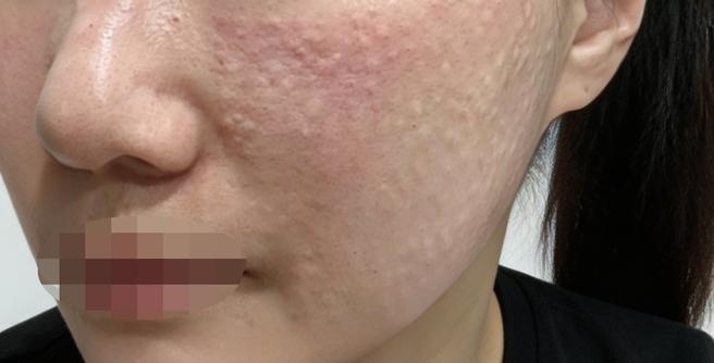미간주름 고민에 건조함까지, 보톡스+리쥬란 동시에 받고 왔어요!!