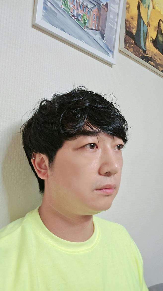 눈밑지방재배치