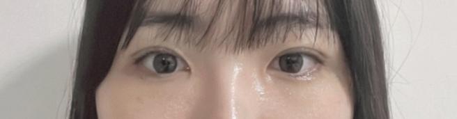자연유착 쌍꺼풀