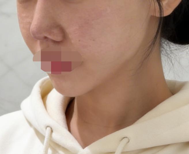 모공 늘어지고 피부결 거칠어진 것 같아서 리쥬란 받으러 방문했어요!