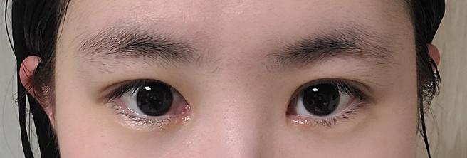 แก้ไขรูปตาและกล้ามเนื้อตาอ่อนแรง