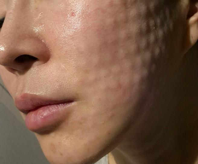 수면마취라 통증 하나도 없었어요~ 간편하고 좋았습니당ㅎㅎ