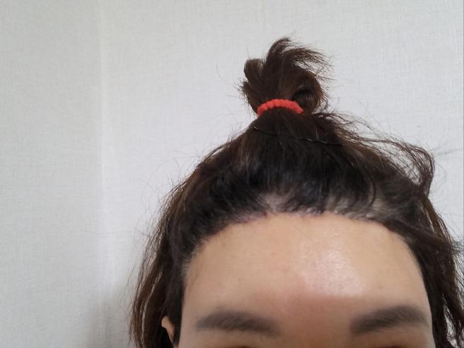 额头缩小术