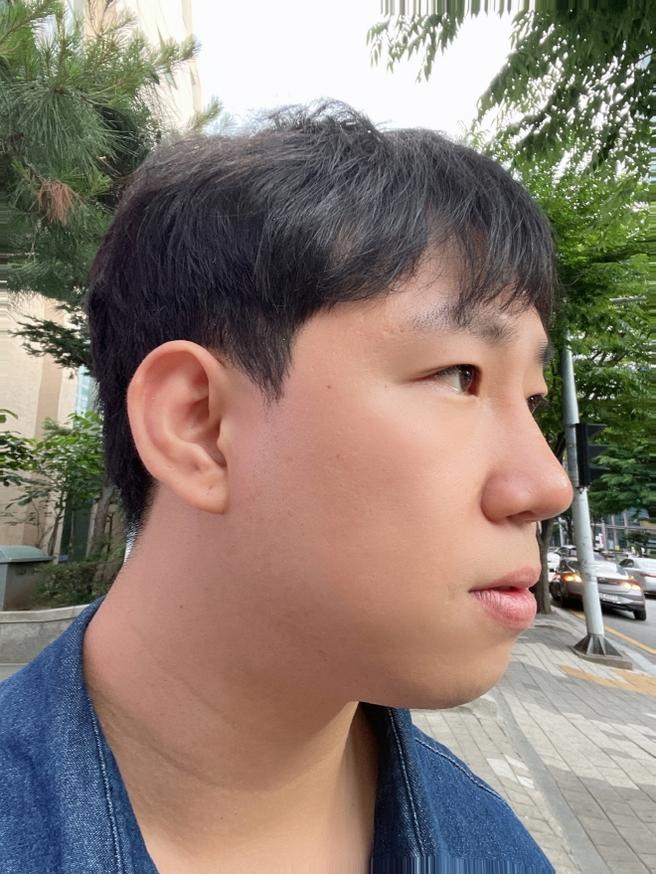 男性隆鼻术