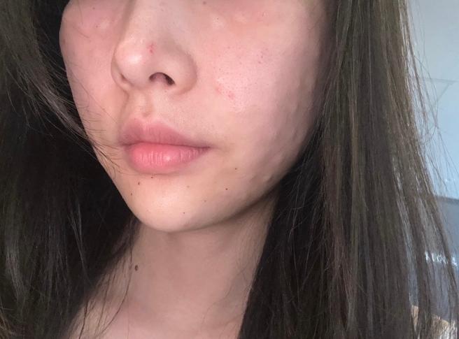 서울아이 리쥬란 당일 !! 꼼꼼하게 시술해주셨어요 :)