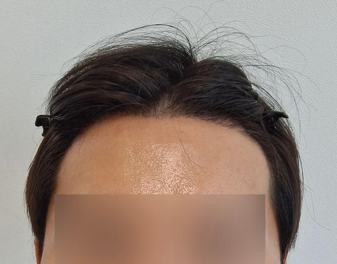 ソウルアイ毛髪移植