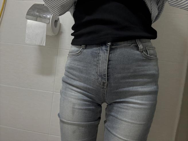 人體脂肪移植