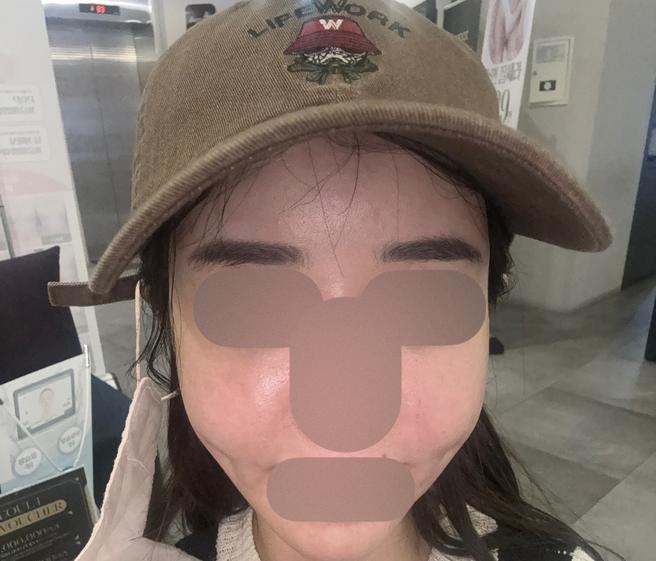 일주일에 한 번 받는데 인모드로 바로 얼굴 작아져서 가성비 갑이에요!