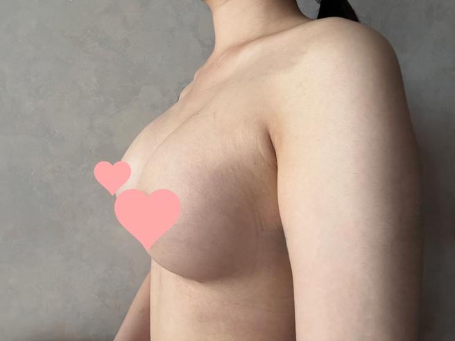내추럴가슴보형물