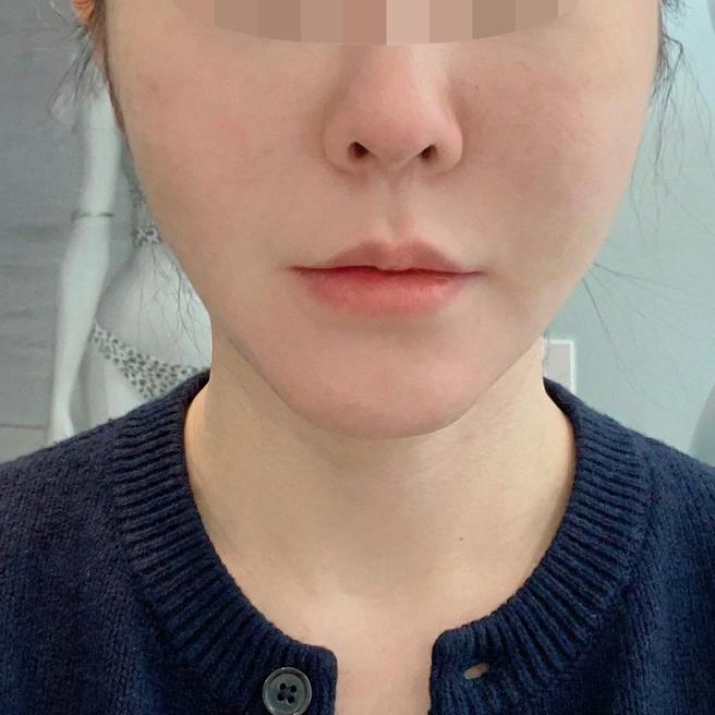 턱라인 살 때문에 온다 받았는데 대만족이에요!