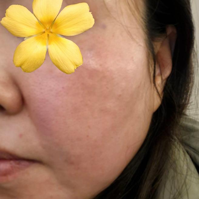 2일차라 아직 울긋불긋한데 촉촉함은 벌써 느껴지는 느낌