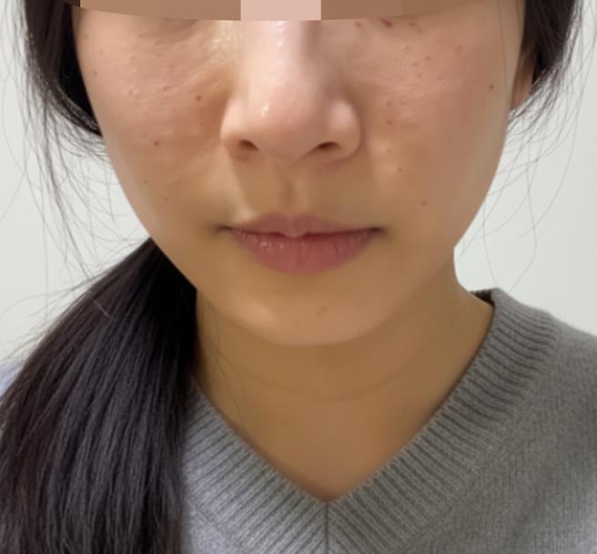 꼼꼼한 시술에 너무 만족! 리쥬란 잘 받고 왔어요