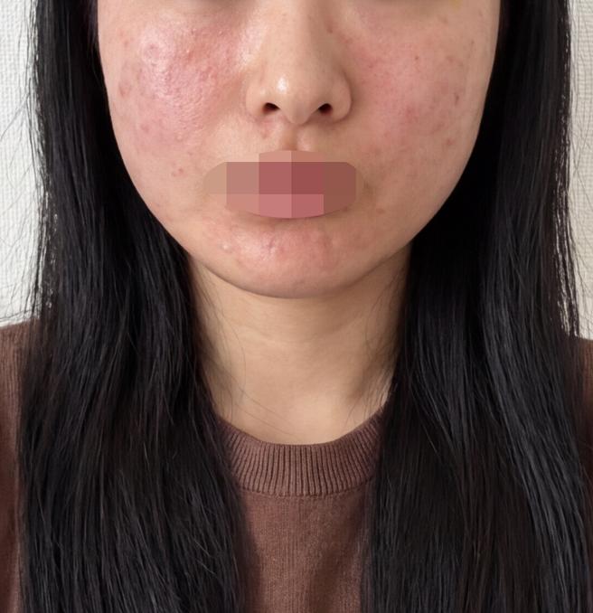 계절 바뀌자마자 피부 당김 심해져서 PRP 받았습니다~