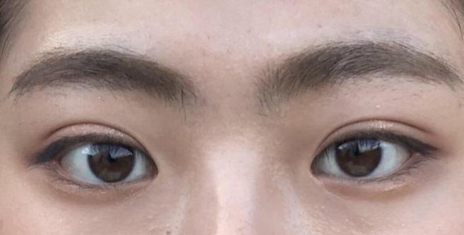 自然粘连双眼皮