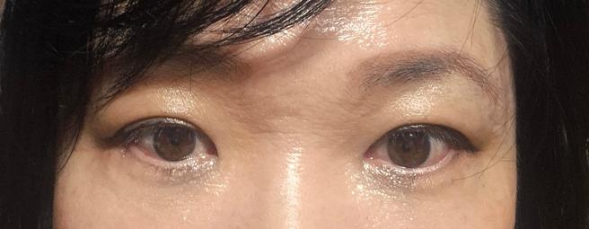 상하안검