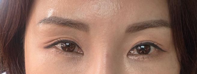 ศัลยกรรมตาแก้ไขอย่างมั่นใจ