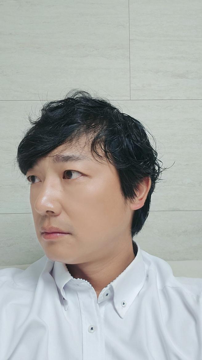 눈밑지방재배치