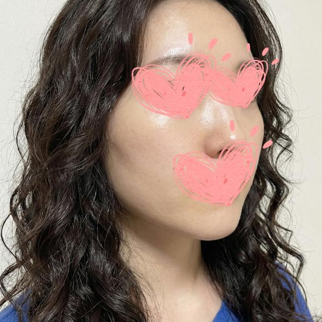 중안부 늘어짐 때문에 슈링크 받았는데 확실히 달라졌어요
