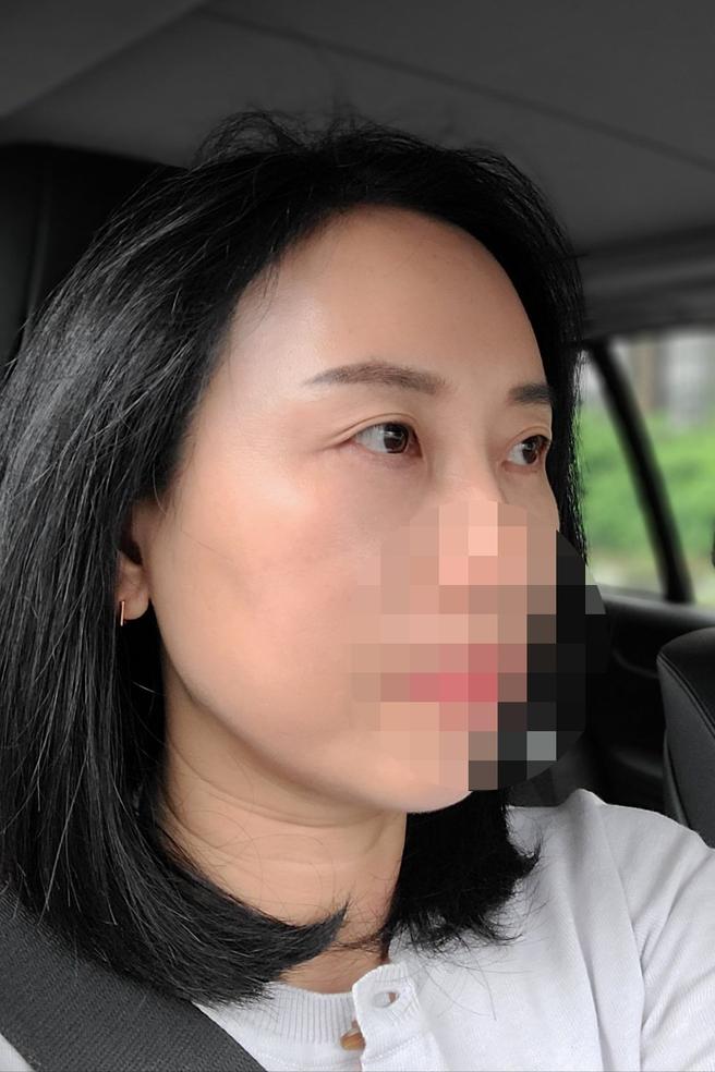 眼下脂肪の再配置