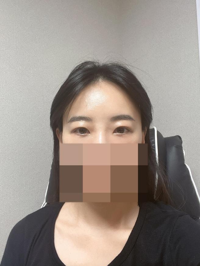 PRP Full Face Fat Graft