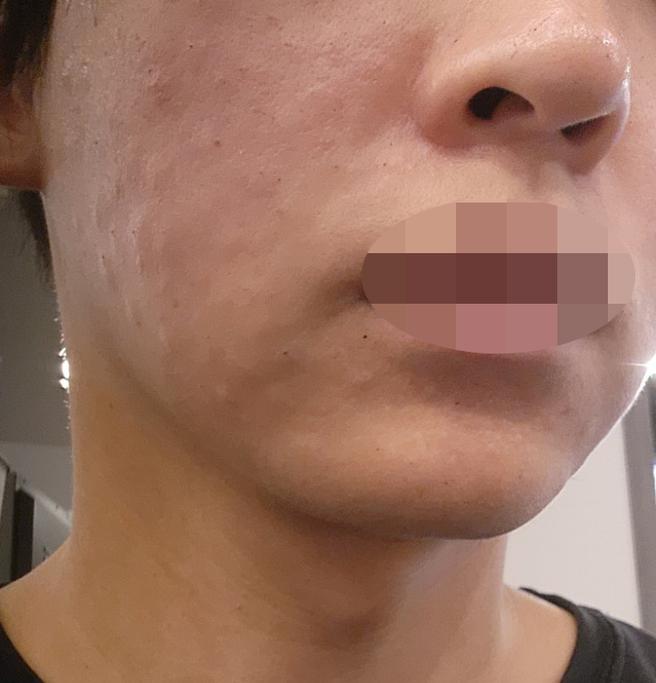 예방 목적으로 수면 리쥬란, 통증 없이 편하게 받았어요!