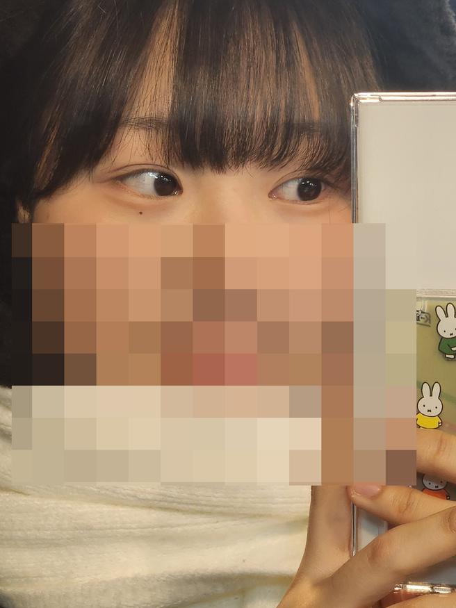 แก้ไขรูปตาและกล้ามเนื้อตาอ่อนแรง