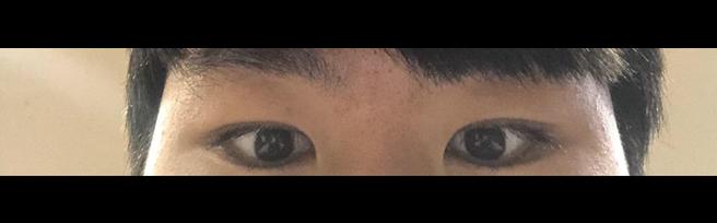 男性眼睛矫正