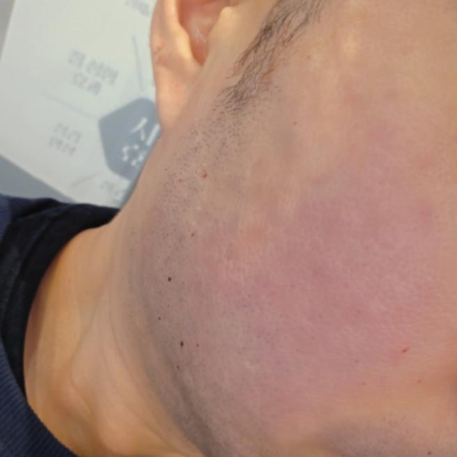 남자 후기 흔치 않죠? 리쥬란 당일 솔직 기록