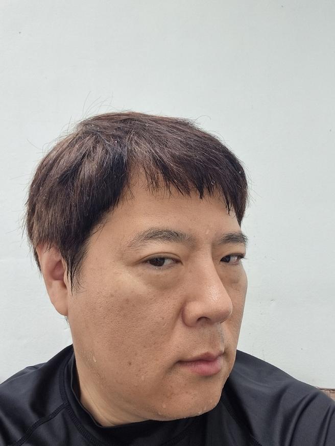 男性鼻整形