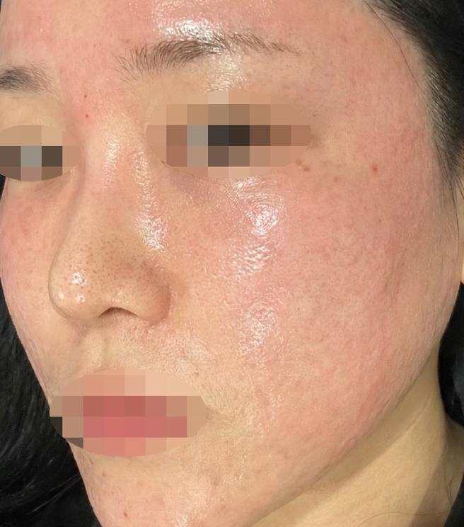 당김 심했는데 리쥬란 받고 촉촉해진 느낌이에요 ㅎㅎ