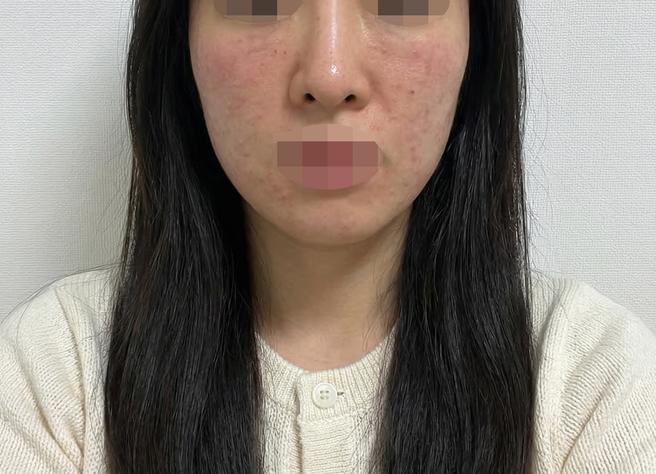 건성이라 리쥬란 꾸준히 받는데 가격도 좋고 케어도 확실해서 만족해요 ㅎㅎ