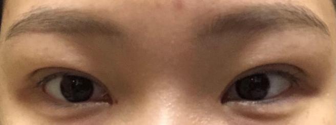 自然粘连双眼皮
