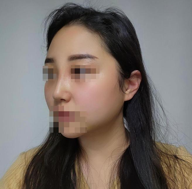 얼굴 지방흡입