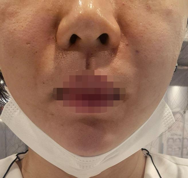 모공 관리 시작하려고 방문했는데 꼼꼼한 시술에 결과까지 기대돼요~