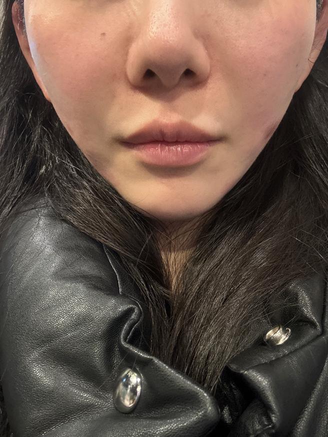 온다리프팅 1주 후기? 단골이니까 믿고 또 왔어요
