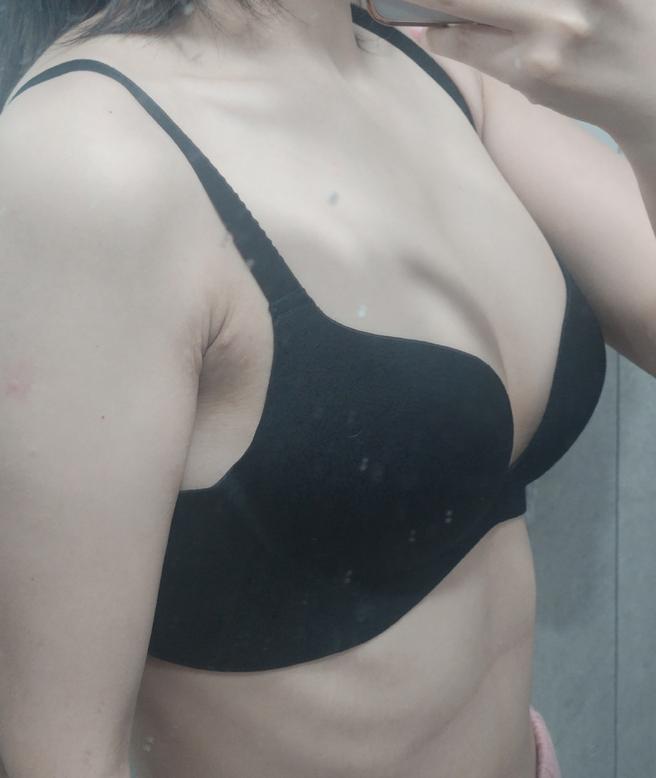 幹細胞胸部脂肪移植