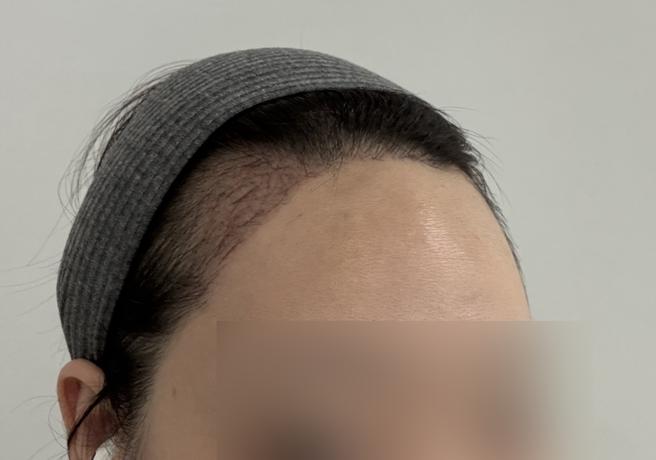 ソウルアイ毛髪移植