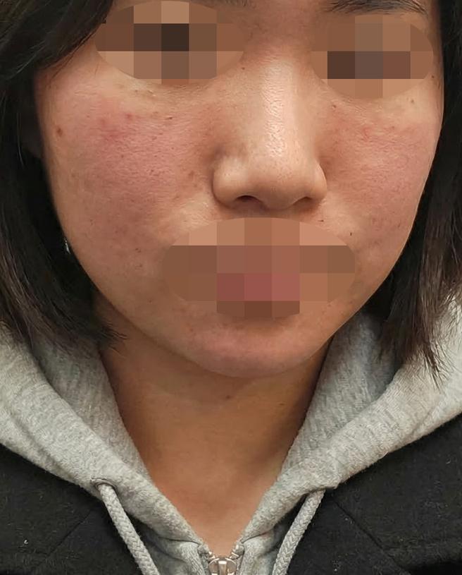 리쥬란이랑 써마지 같이 받았는데 수면이라 편한 것 같아요 ㅎㅎ