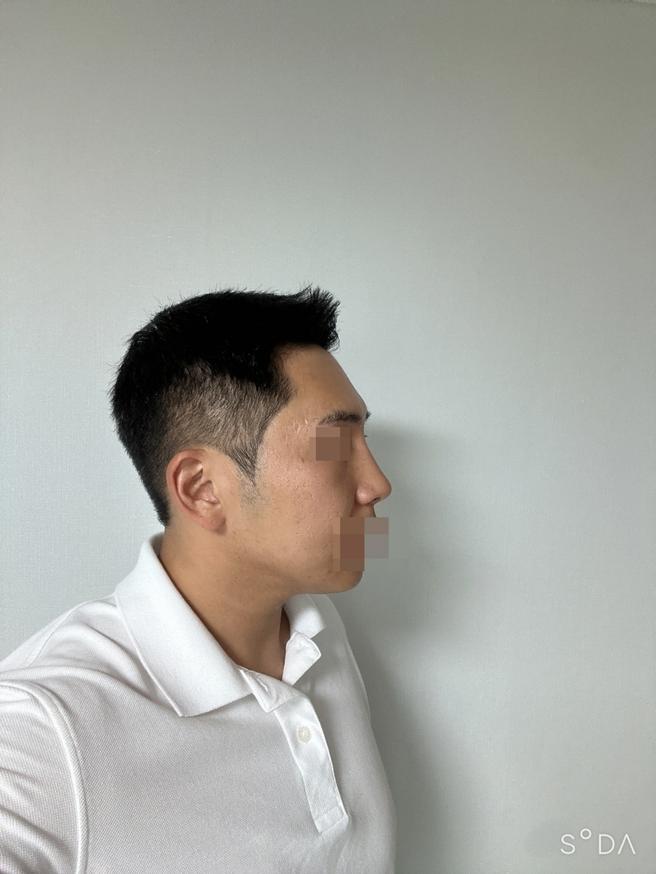男性隆鼻术