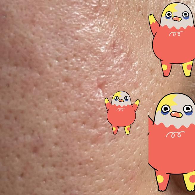 쥬베룩 5일차, 붉은기가 많이 가라앉았어요